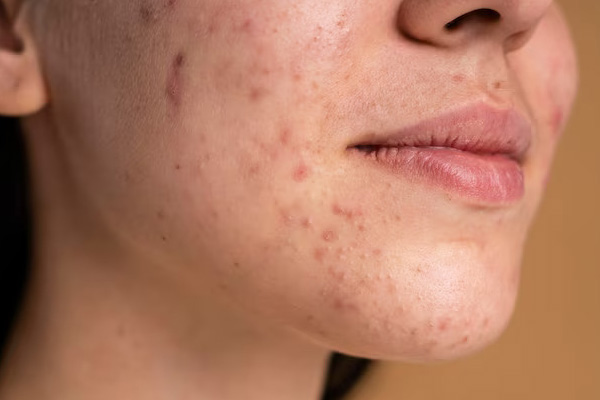 Imagen-1-acne-hormonal_1